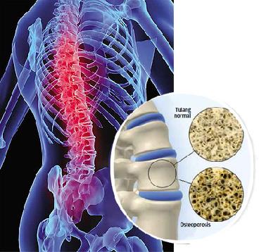 Bahaya Rokok Bisa bikin Tulang Jadi Rapuh
