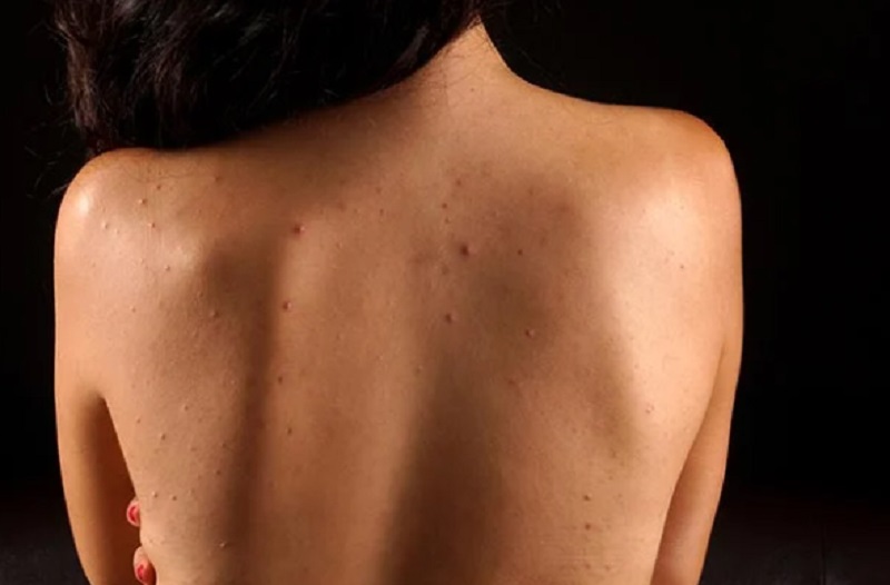 Berikut 5 Tips Mengatasi Jerawat di Punggung