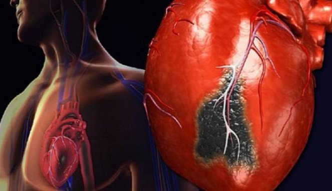 Bahaya, Ini Dia 4 Kondisi yang Bisa Picu Penyakit Jantung