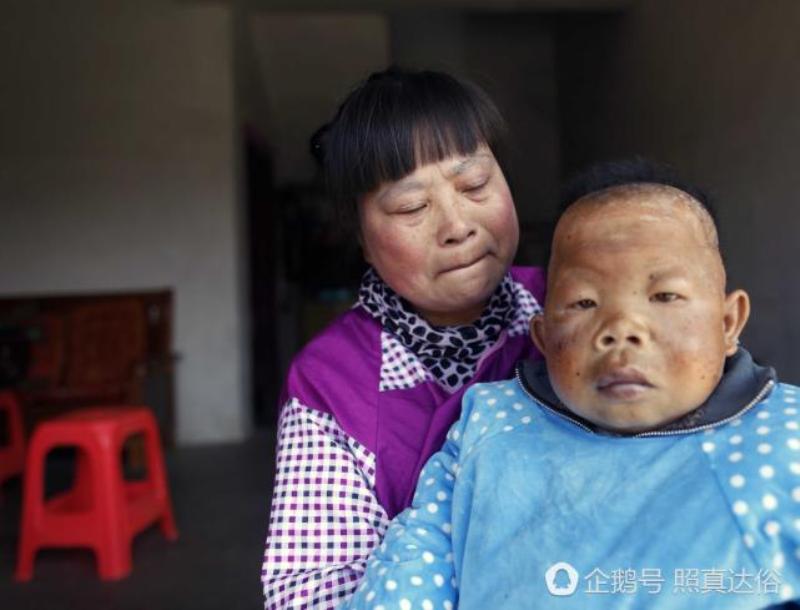 Idap Penyakit Misterius, Pria Berusia 30 Tahun Mirip Seorang Balita