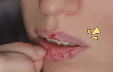 Stop! Jangan Dijilat Jika Tak Ingin Bibir Kering, Nih Cara Mengatasinya