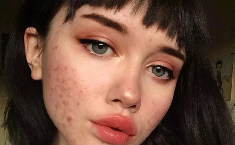 Lima Perawatan Rumahan untuk Menghilangkan Blackhead