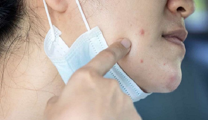 Berikut Cara Mengatasi Jerawat karena Sering Menggunakan Masker