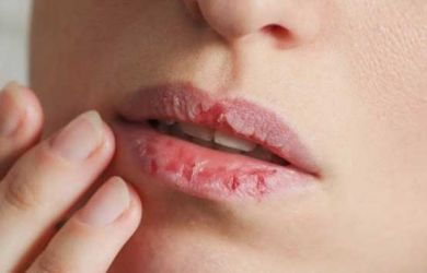 Ini Tips Merawat Bibir Kering Saat Puasa di Bulan Ramadhan