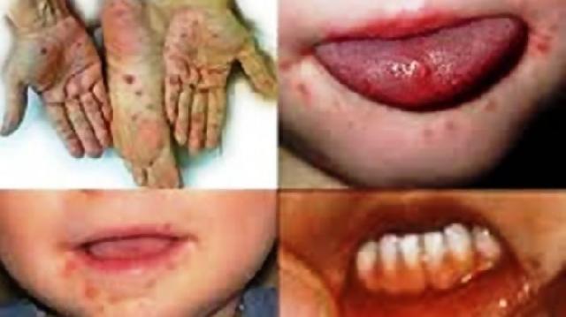 Heboh !! Flu Singapura Mewabah, Masyarakat Harus Waspada