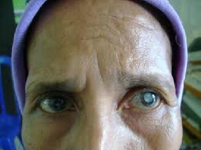 Enam Orang Warga Desa Kota Lama Rengat, Positif Mengidap Penyakit Katarak