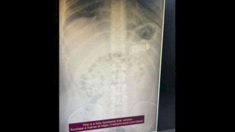 Percaya Tidak Percaya, Orang Ini Telan Ponsel Nokia 3310