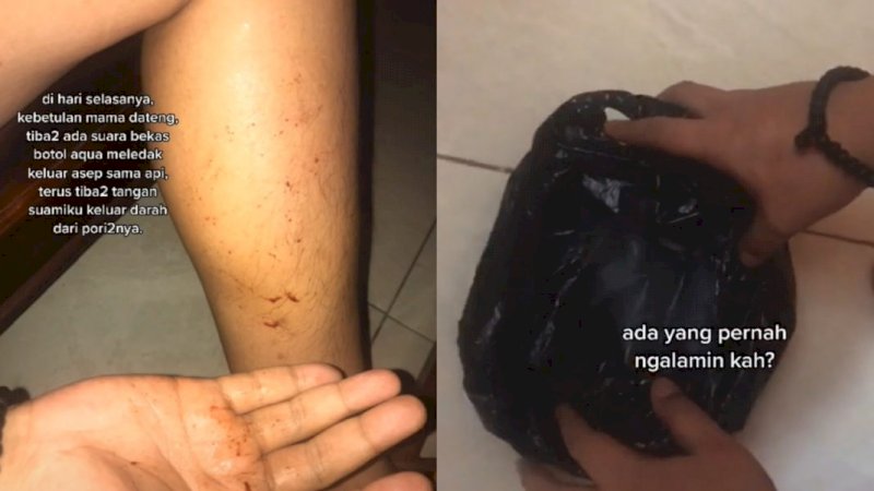Merinding! Cerita Mistis Istri, Kaki Suaminya Tiba-tiba Mengeluarkan Darah