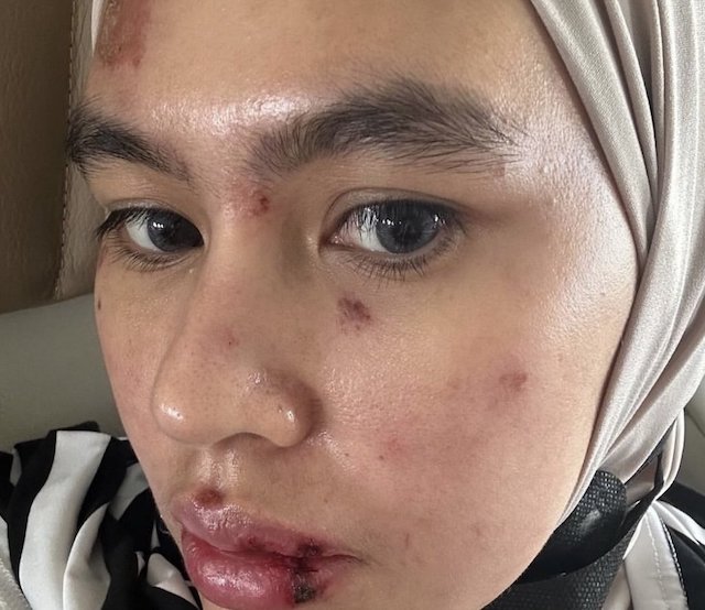 Penyebab Ruam dan Lepuh pada Wajah Kartika Putri Akhirnya Terungkap