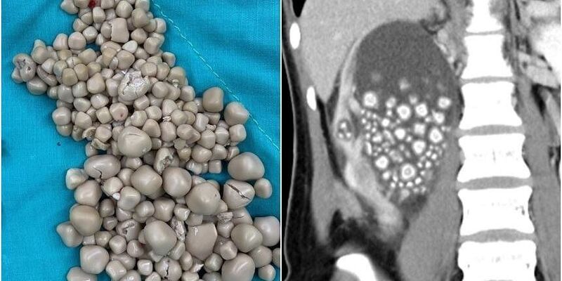 Dokter Taiwan Keluarkan 300 Batu Ginjal dari Pasien yang Suka Minuman Boba