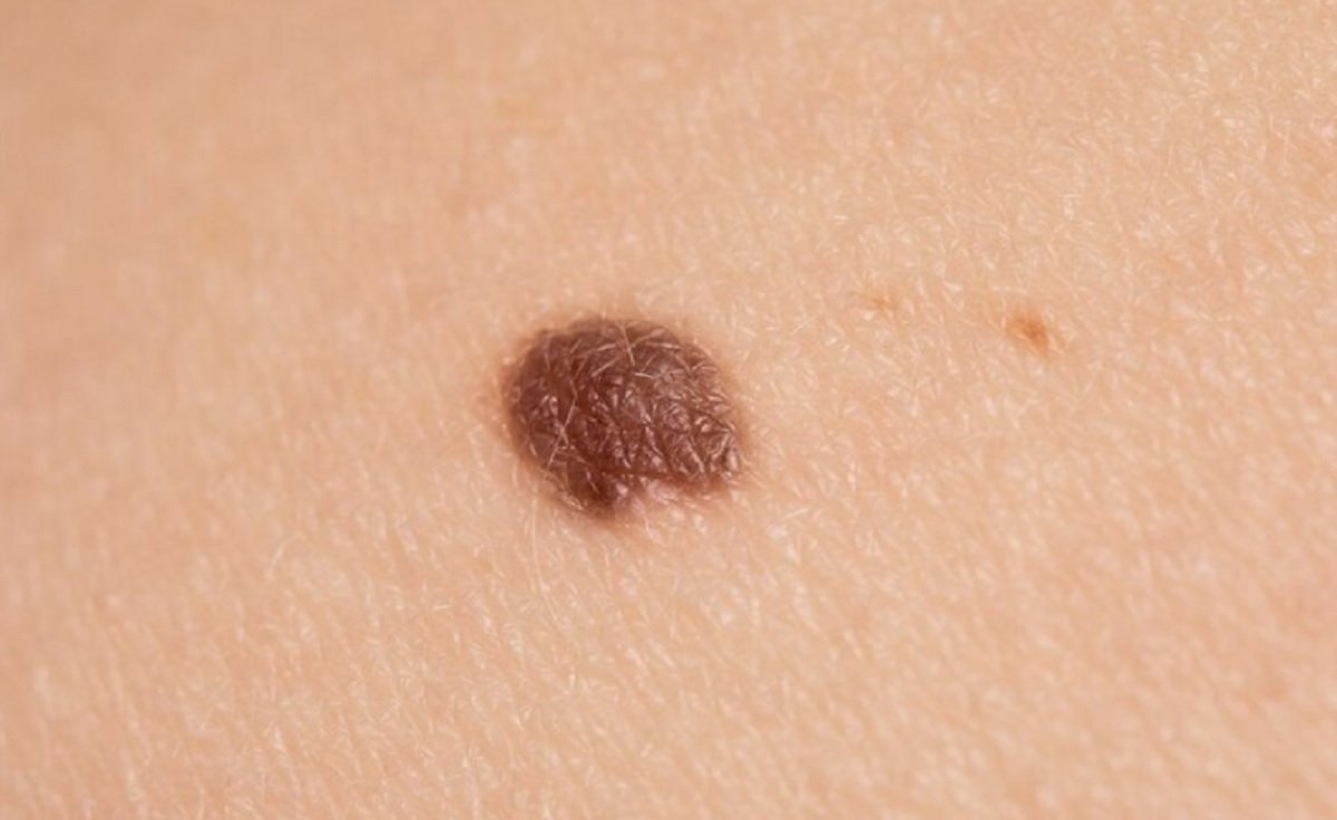 Miliki Tahi Lalat di Kaki, YouTuber Ini Didiagnosis Kanker