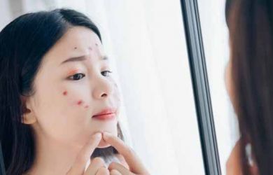 Ini Penyebab Anak Usia SD Zaman Sekarang Banyak Sekali yang Sudah Miliki Jerawat