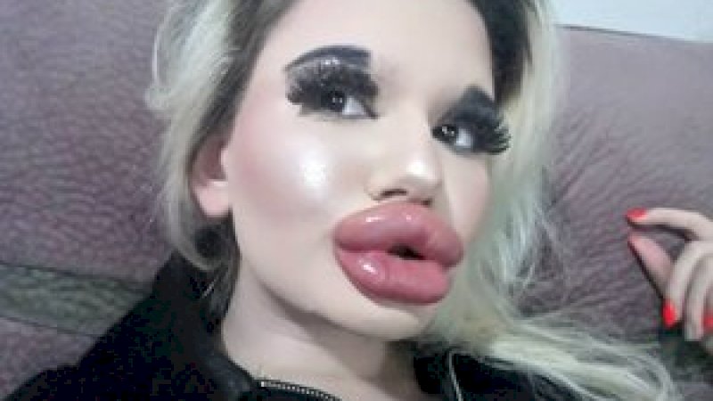 Hampir Menyentuh Hidung, Inilah Wanita Pemilik Bibir Terbesar di Dunia