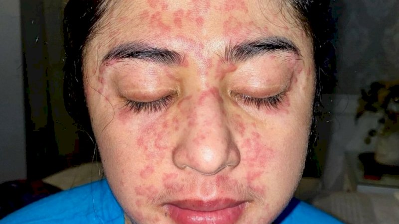 Penjelasan Medis Terkait Wajah Dewi Persik yang Alami Ruam Merah Usai Terpapar Covid-19