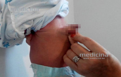 Langka, Seorang Bayi Lahir dengan Penis Ganda