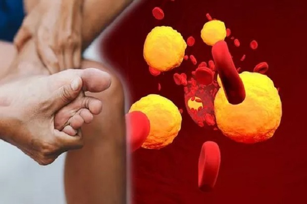 Ini Gejala Kolesterol Tinggi di Kepala, Tangan dan Kaki