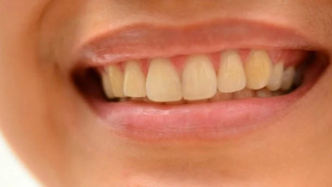 Minum Kopi Bikin Gigi Jadi Kuning? Atasi dengan Cara Ini