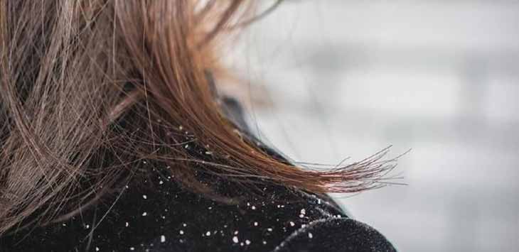 Ini Dia 5 Bahan Alami Ampuh Hilangkan Ketombe