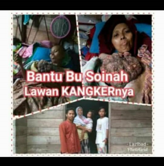 Terserang Kanker Payudara, Soinah Butuh Uluran Tangan Dermawan