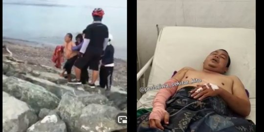 Diserang Buaya Hingga Tangannya Putus, Kondisi Tangan Korban Kini Berhasil Disambung Tim Dokter