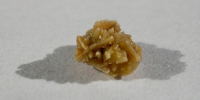 Berikut Tanda Munculnya Batu Ginjal yang Perlu Kamu Waspadai