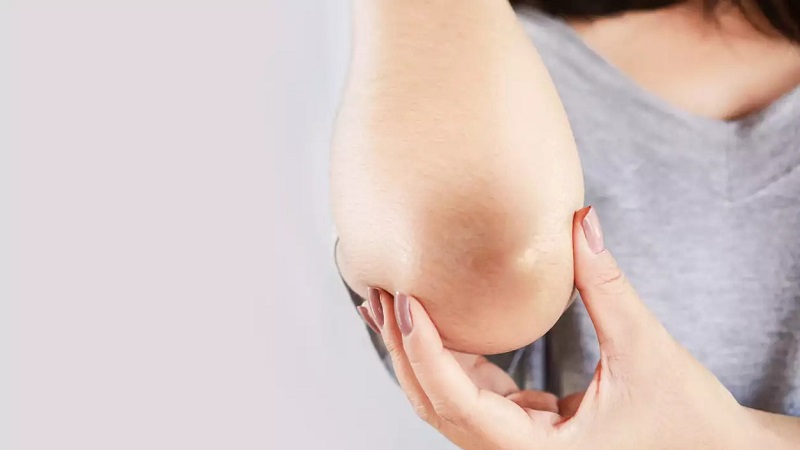 Berikut Perawatan Kecantikan untuk Atasi Sikut Gelap