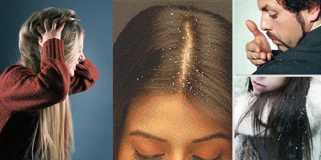 7 Fakta mencengangkan tentang ketombe yang jarang diketahui