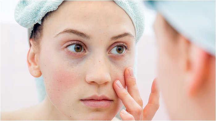 Yuk Dicoba, Begini Caranya Hilangkan Kantung Mata Hitam!