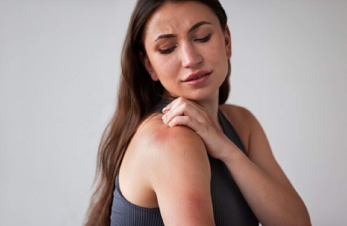 Berikut 5 Tips Mengatasi Biduran di Musim Hujan