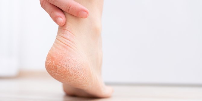 Tiga Kebiasaan yang Tanpa Disadari Bisa Membuat Tumit Kering dan Pecah-Pecah