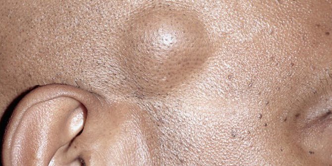 Mengenal Penyakit Lipoma, dari Penyebab hingga Cara Mengatasinya