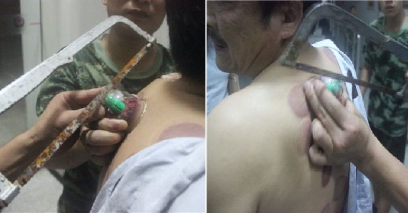 Aduh... Salah Lakukan Bekam, Gelas di Punggung Pria Ini Terpaksa Digergaji