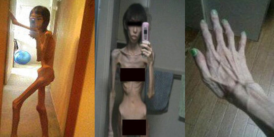 Pernah kurus kering hanya tinggal tulang, penampilan wanita ini sekarang bikin syok