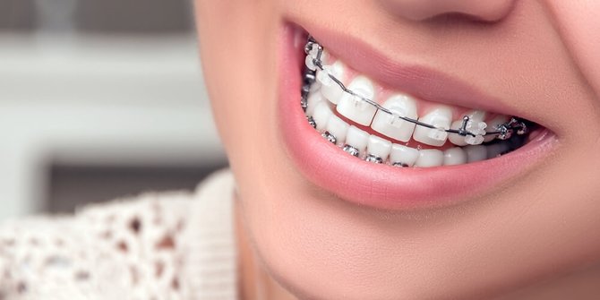 Makanan yang Boleh dan Tak Boleh Dimakan Setelah Pasang Behel