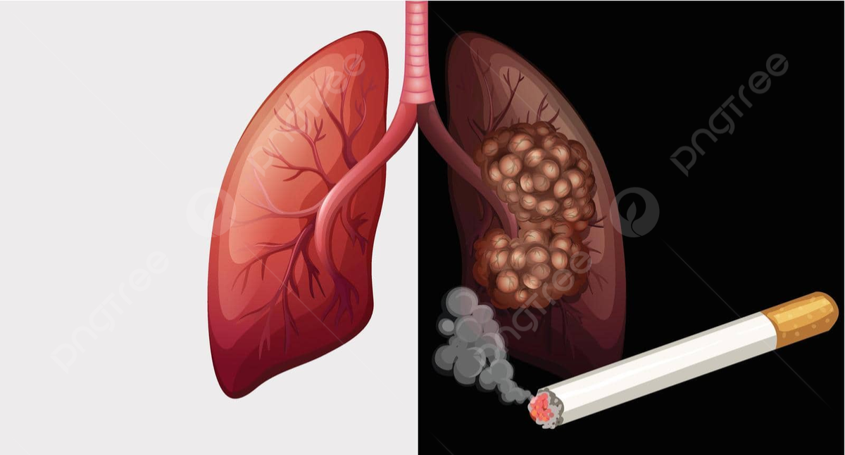Tekan Kanker Paru, Masyarakat Bisa Akses Layanan Berhenti Merokok ke 21 Puskesmas di Pekanbaru