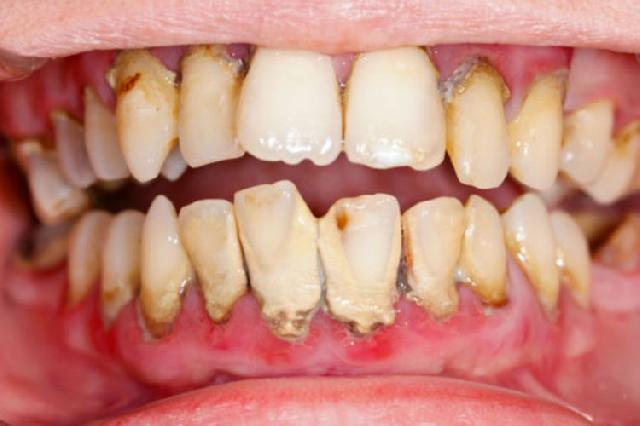Gigi berkarang, bersihkan dengan cara ini