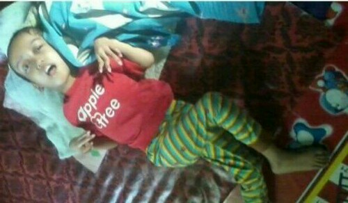 Kisah Pilu Nursela, 13 Tahun Lumpuh Usai Imunisasi