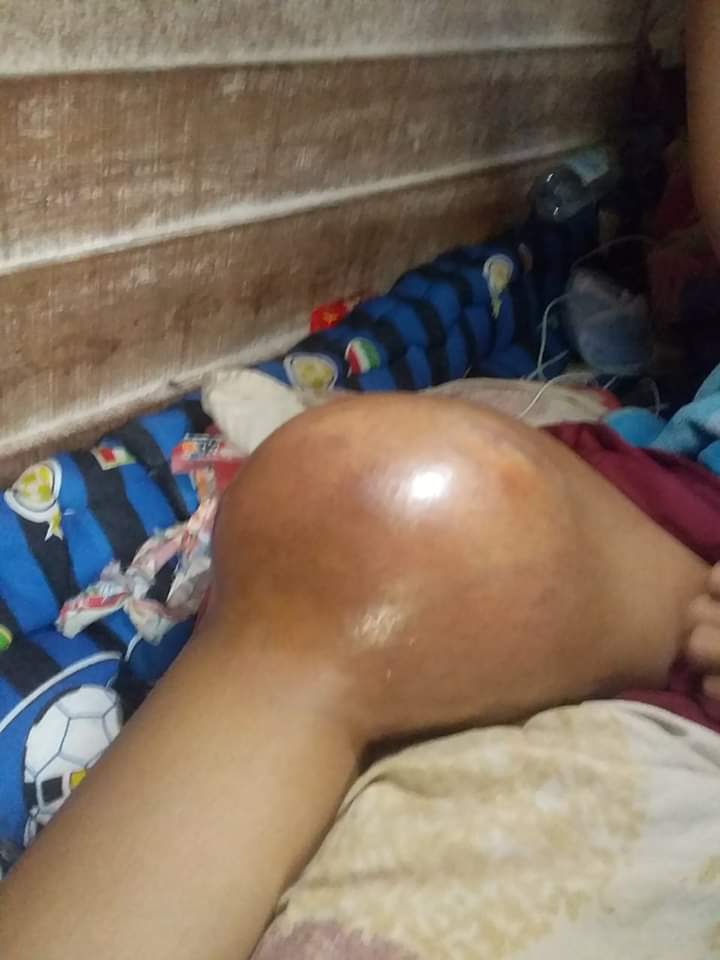 Yuk! Warga Riau Bantu Penderitaan Riska Ramadila Pelajar Penderita Tumor Stadium Empat