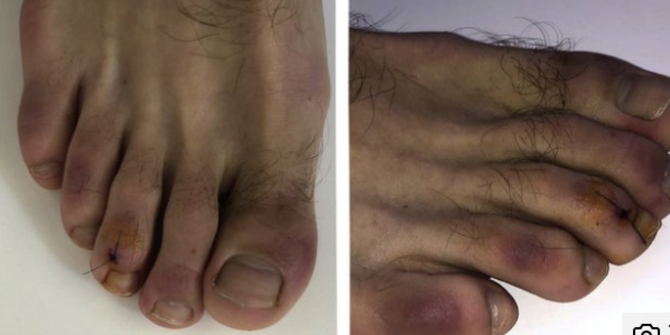 'Jari Kaki Covid', Peradangan yang Dialami Pasien Virus Corona