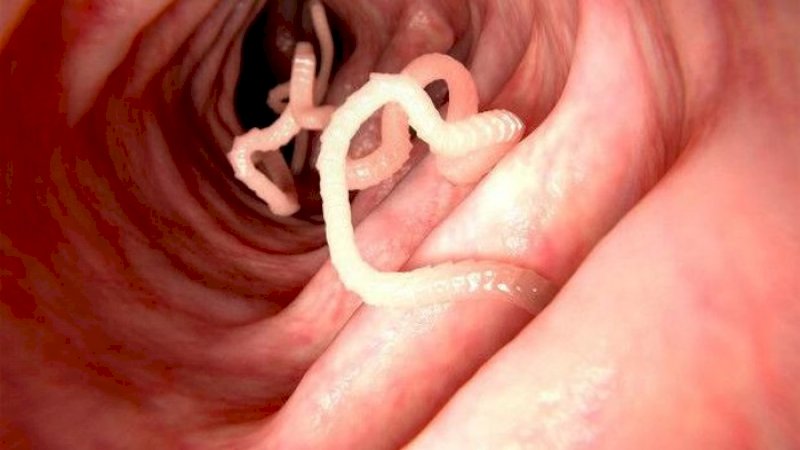 Karena Makan Daging Mentah, Cacing Pita 5 Meter Bersarang di Tubuh Pria Ini