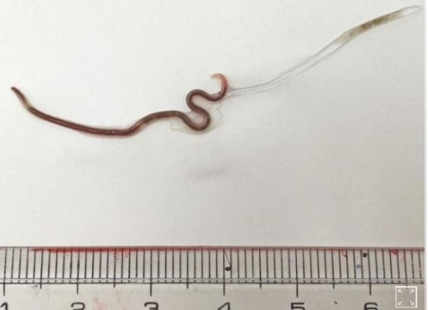 Dokter di Jepang Keluarkan Cacing Hidup dari Amandel Perempuan Ini