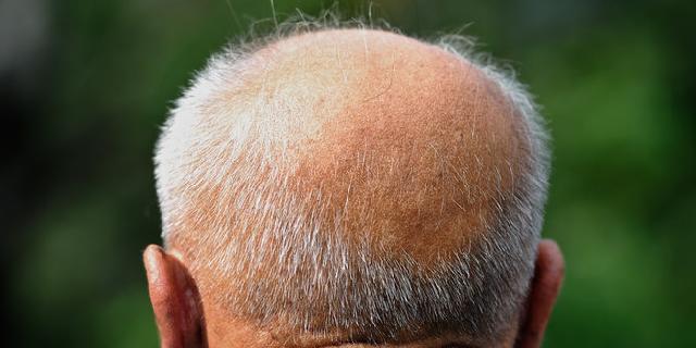 Sering pakai topi bikin kepala botak?