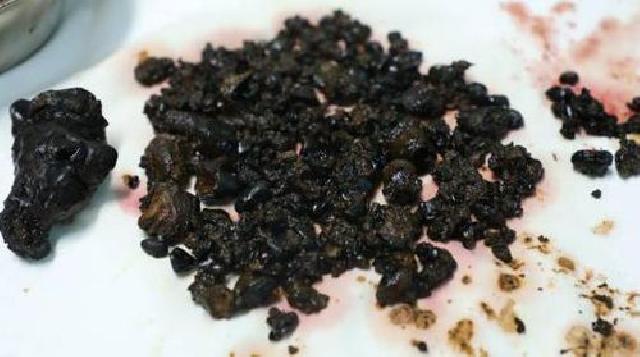 Wanita Ini Jarang Sarapan, Ratusan Batu Empedu Ditemukan di Tubuhnya