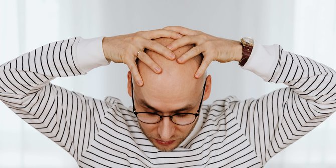 Kebotakan Bisa Terjadi di Usia Mudah dan Bahkan Dialami Wanita