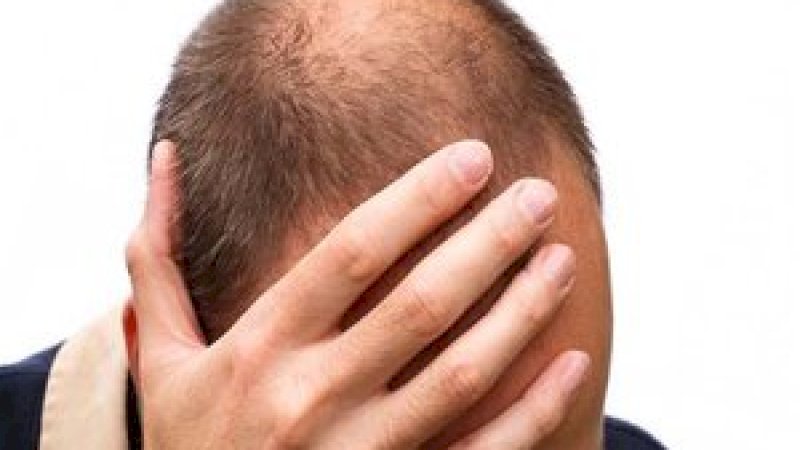 Suami Dipolisikan Istri karena Sembunyikan Kebotakan saat Nikah