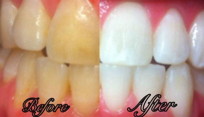 Resep Rumahan Memutihkan Gigi Hanya dalam 7 Hari