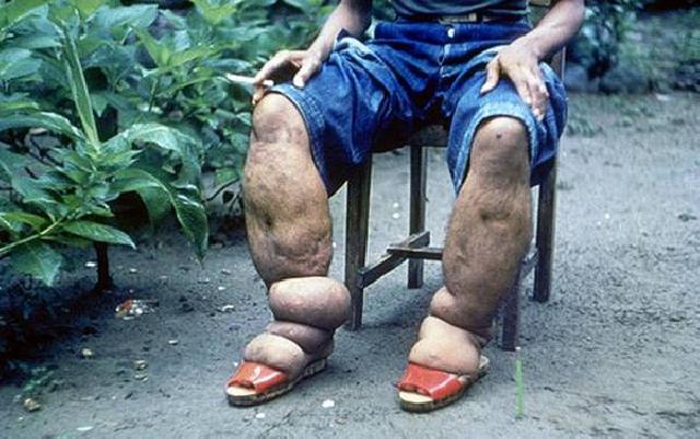 Dinkes Siak Temukan 18 Orang Penderita Penyakit Kaki Gajah