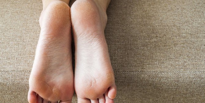 Enam Cara Mudah dan Sederhana Mengatasi Tumit dan Kaki Pecah-Pecah