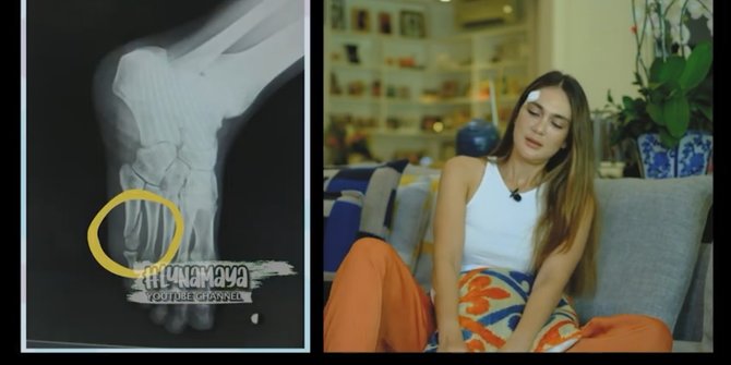 Kondisi Luna Maya Usai Alami Kecelakaan Sepeda, Tangan Dijahit dan Kaki Retak