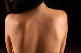 Berikut 5 Tips Mengatasi Jerawat di Punggung